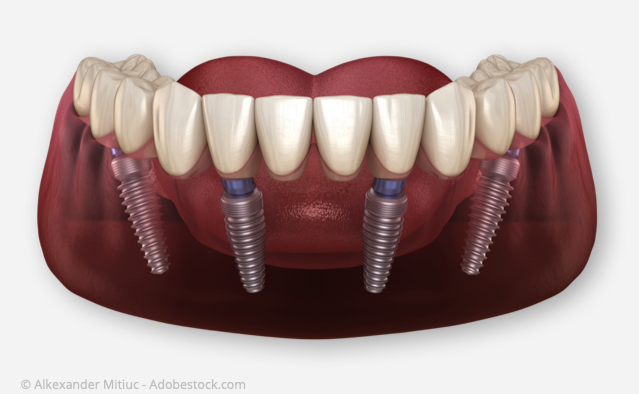 All-on-Four: Nur vier Implantate pro Kiefer für feste Zähne
