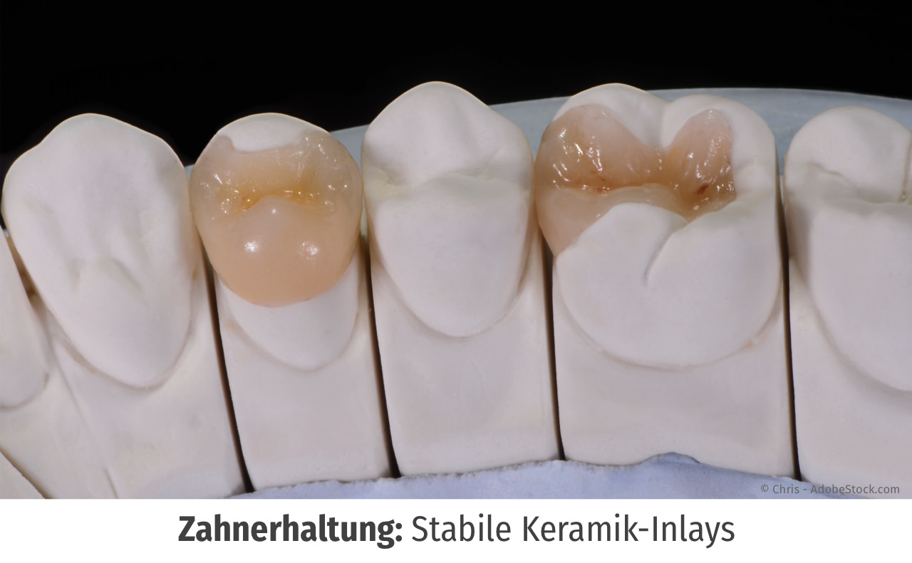 Weiße Zahnfüllungen - Inlay oder Komposit - Dorow Clinic